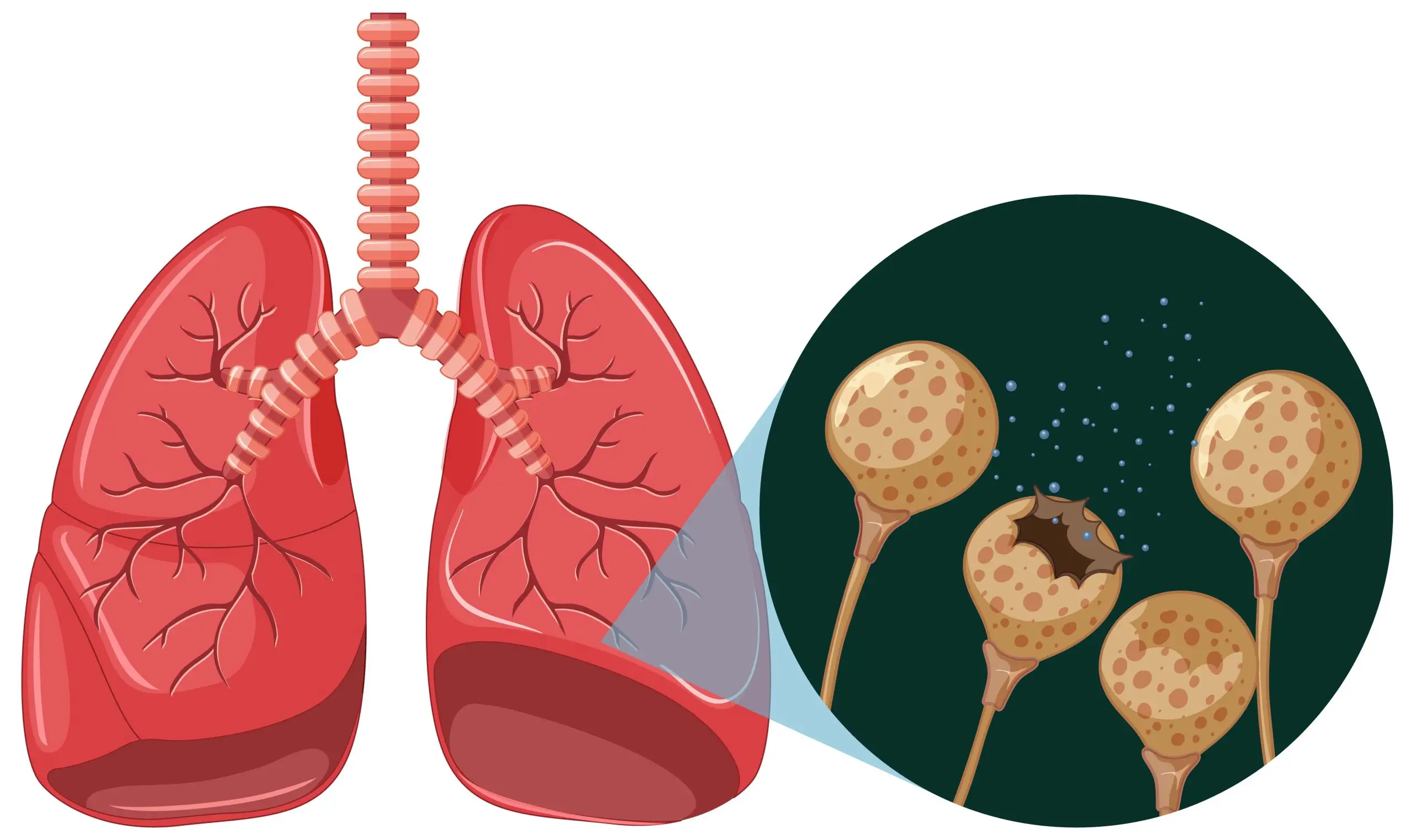 What Are the 14 Symptoms of Bronchiectasis? What Causes Bronchiectasis?