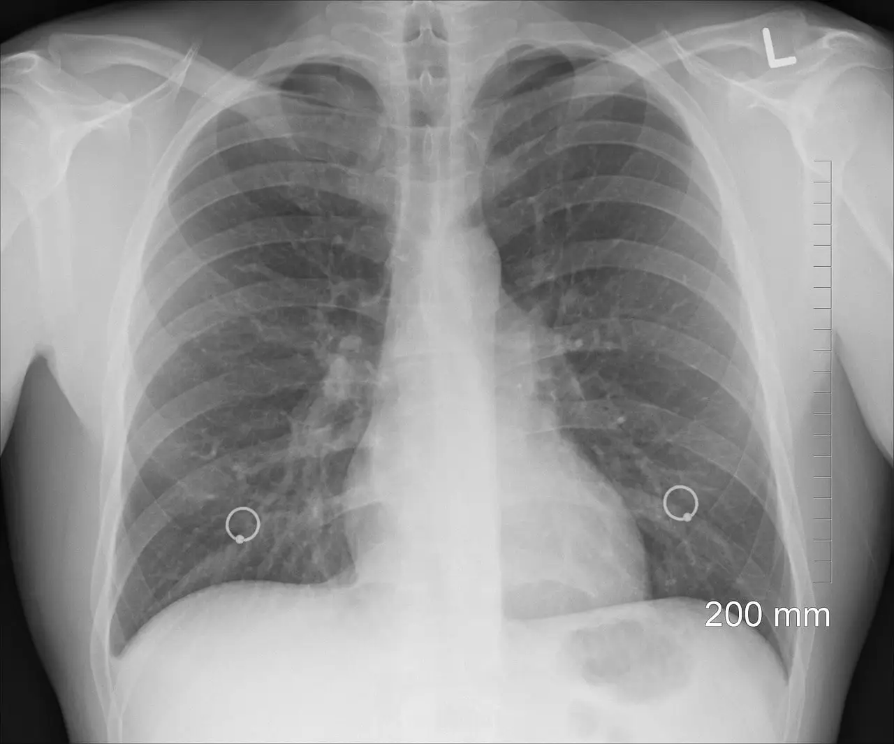 Air Accumulation in the Lungs