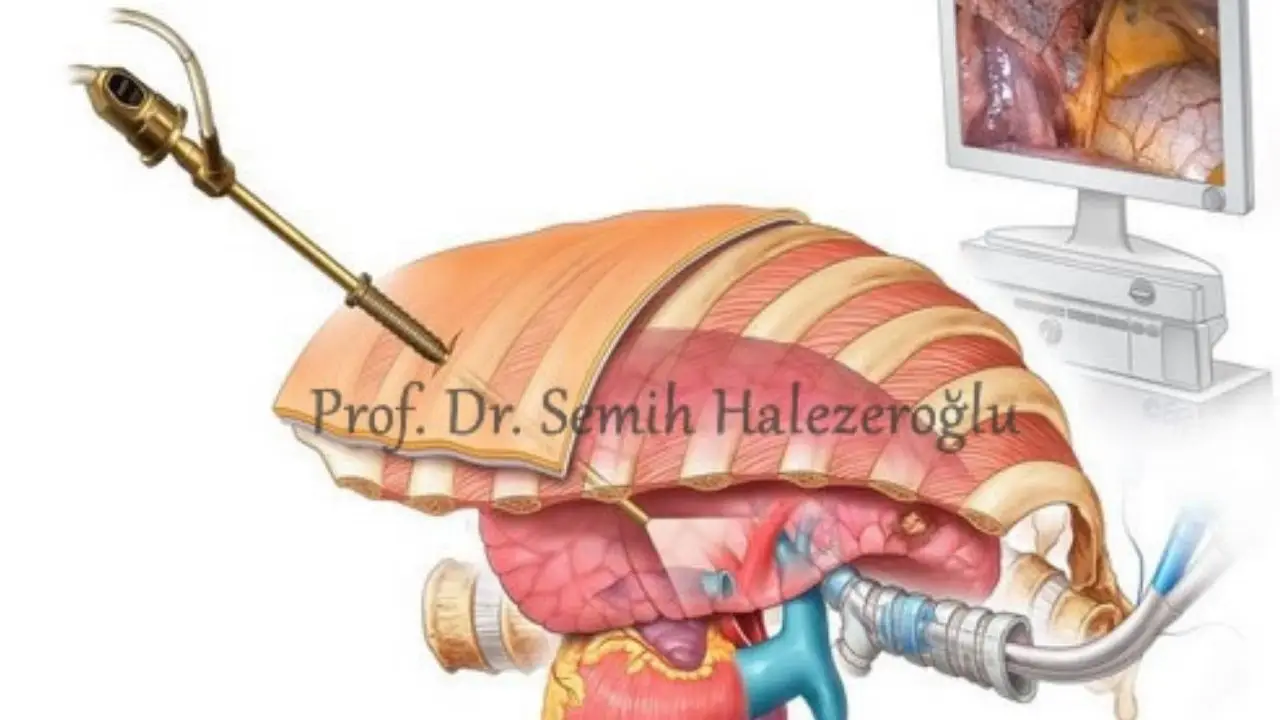 Single Port Thoracoscopy Surgery in Lung Cancer