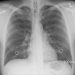 Lung Cancer X-Ray