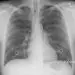 Lung Cancer X-Ray