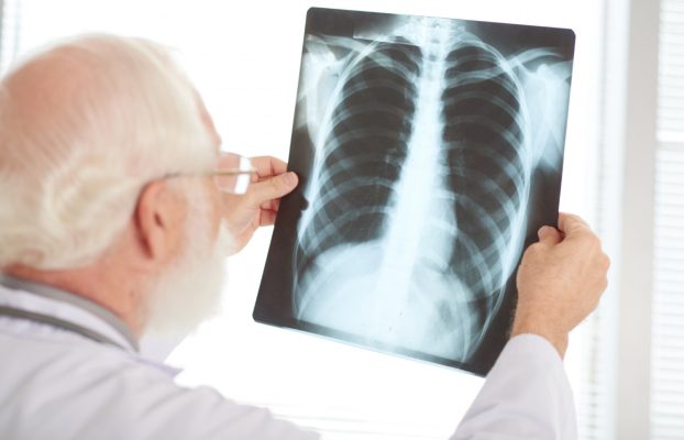 Sağ Akciğerde Nodüler Lezyon Nedir? Kansere Dönüşür mü?