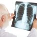 What Causes Lung Nodules